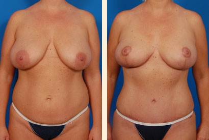 Abdominoplasty Before and After 01