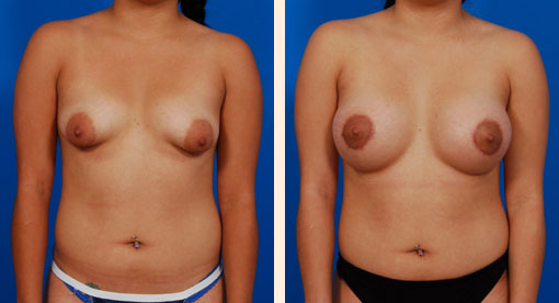 Breast Lift Before and After 01
