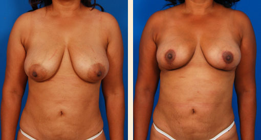 Breast Lift Before and After 01