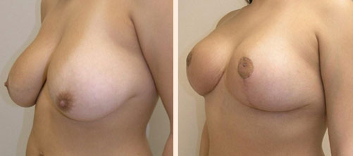 Breast Reduction Before and After 01