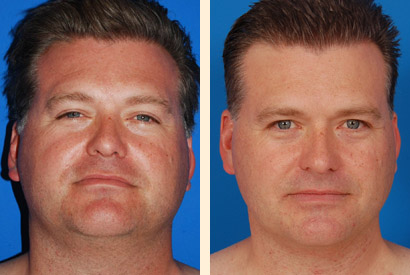 Face And Neck Liposuction Before and After 01