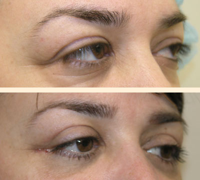 Traditional Eyelid Lift Before and After 01