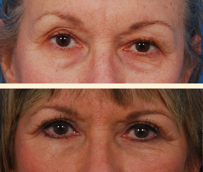 Traditional Eyelid Lift Before and After 01