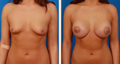 Breast implants and big nipples Correction Of Tuberous Breast Hoefflin Plastic Surgery