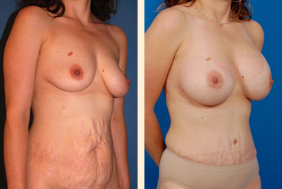 Abdominoplasty Before and After 02