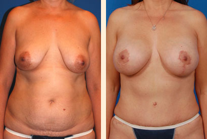 Abdominoplasty Before and After 11