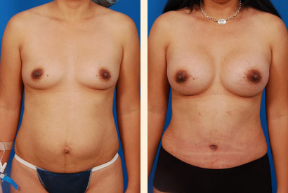 Abdominoplasty Before and After 12