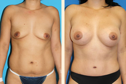 Abdominoplasty Before and After 03