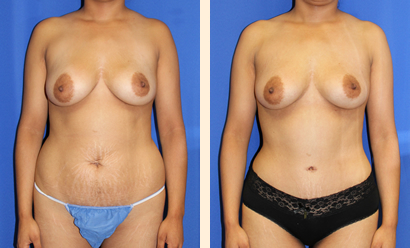 Abdominoplasty Before and After 08