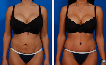 Abdominoplasty Before and After 04