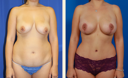 Abdominoplasty Before and After 06