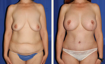Abdominoplasty Before and After 13