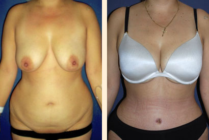 Abdominoplasty Before and After 08