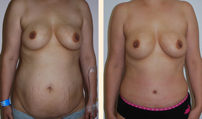 Abdominoplasty Before and After 12
