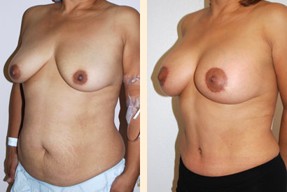 Abdominoplasty Before and After 21