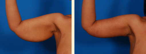 Arm Liposuction And Arm Lifts Before and After 02