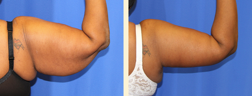 Arm Liposuction And Arm Lifts Before and After 02