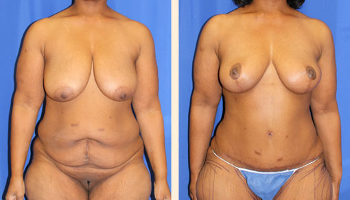 Body Contouring After Major Weight Loss Before and After 01