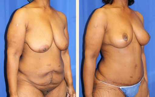 Body Contouring After Major Weight Loss Before and After 02