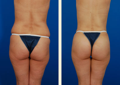 Brazilian Butt Lift Before and After 04