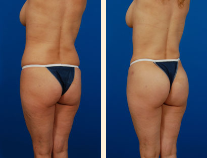 Brazilian Butt Lift Before and After 01