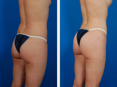 Brazilian Butt Lift Before and After 02