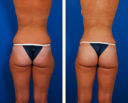 Brazilian Butt Lift Before and After 01