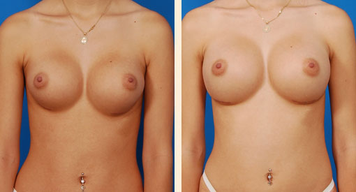 Breast Asymmetry Before and After 04