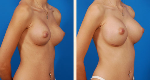 Breast Asymmetry Before and After 01