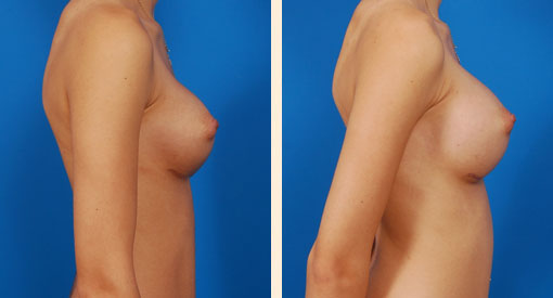 Breast Asymmetry Before and After 01