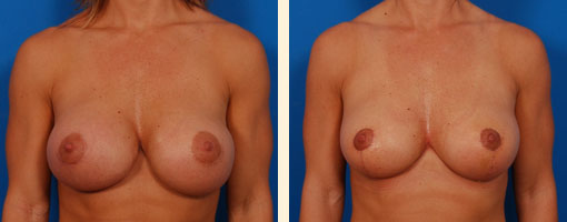 Breast Asymmetry Before and After 08