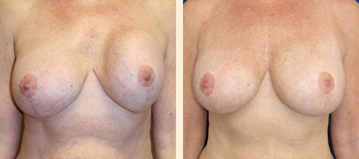 Breast Asymmetry Before and After 08