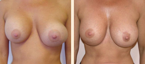 Breast Asymmetry Before and After 07