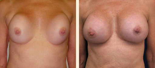 Breast Asymmetry Before and After 09