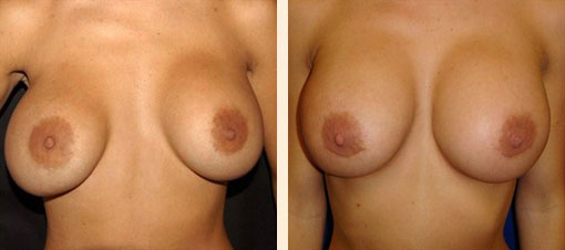 Breast Asymmetry Before and After 06