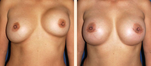 Breast Asymmetry Before and After 02