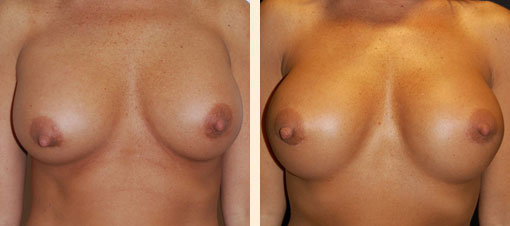 Breast Asymmetry Before and After 04