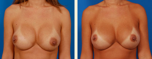 Breast Asymmetry Before and After 07