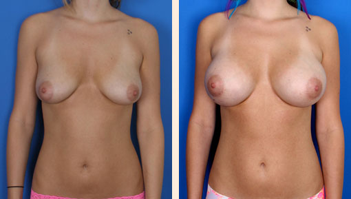 Breast Augmentation Before and After 35