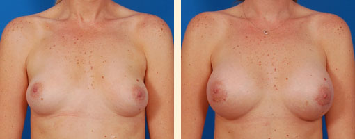 Breast Augmentation Before and After 25