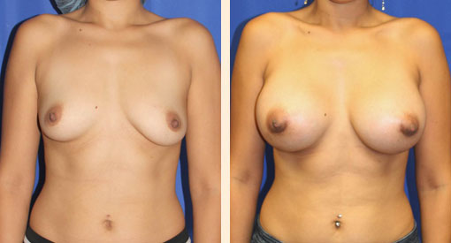 Breast Augmentation Before and After 33