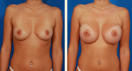 Breast Augmentation Before and After 35