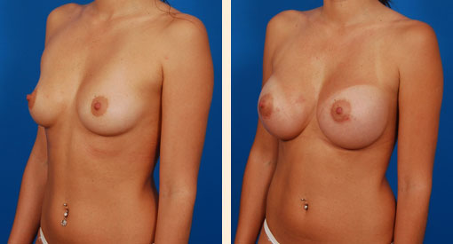 Breast Augmentation Before and After 11