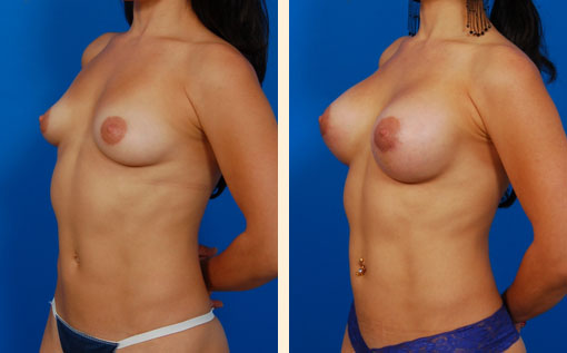 Breast Augmentation Before and After 05