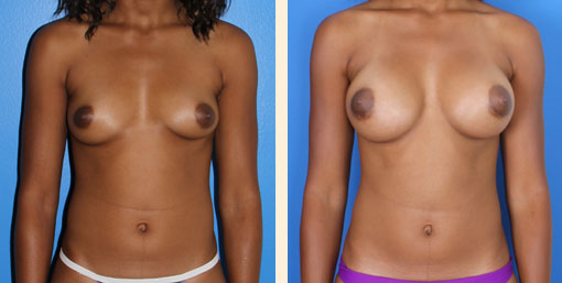 Breast Augmentation Before and After 29