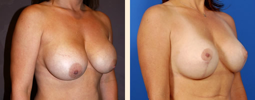 Breast Augmentation Before and After 23