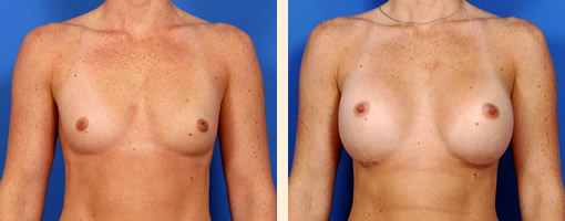 Breast Augmentation Before and After 30