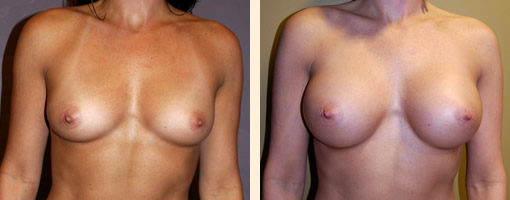 Breast Augmentation Before and After 15