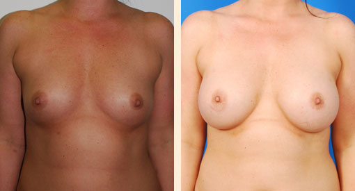 Breast Augmentation Before and After 03