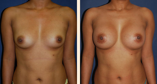 Breast Augmentation Before and After 10